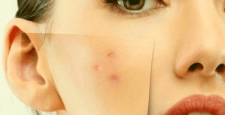 cicatrici da varicella