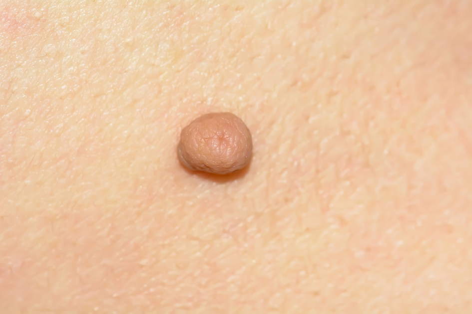 papilloma pendulo papillomavirus tomber enceinte