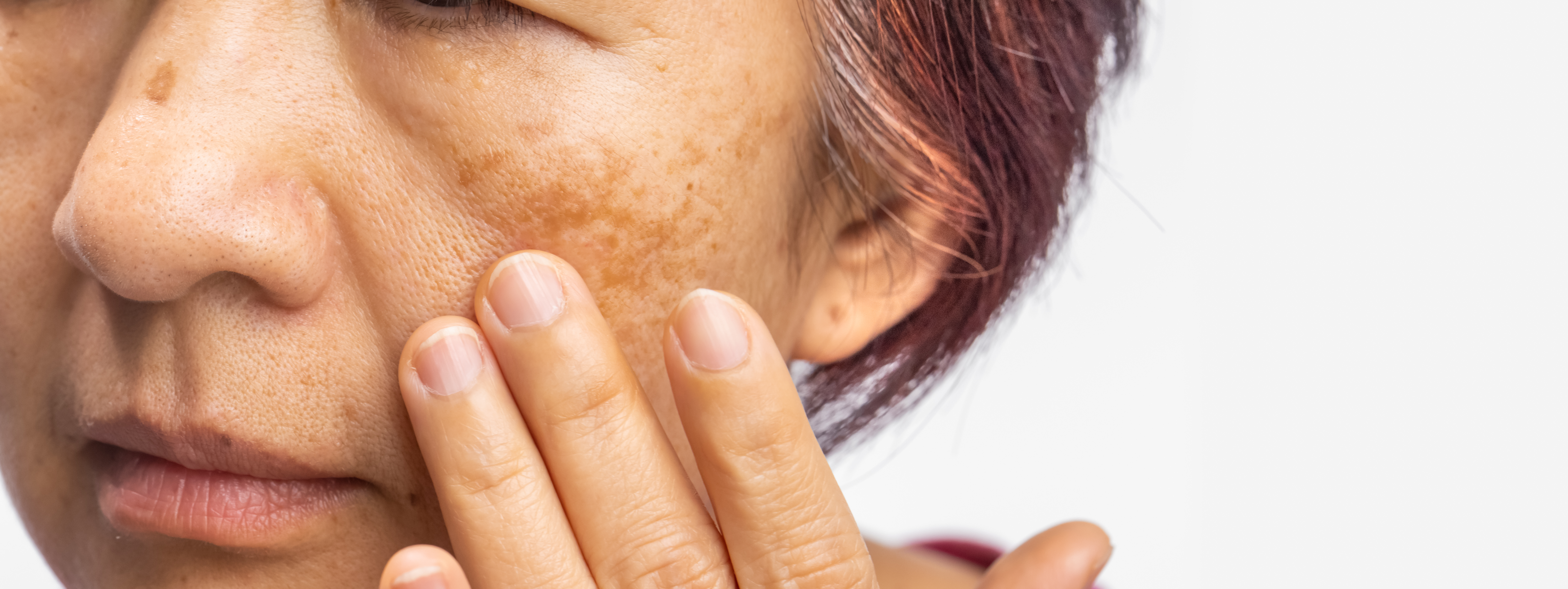 macchie della pelle- melasma