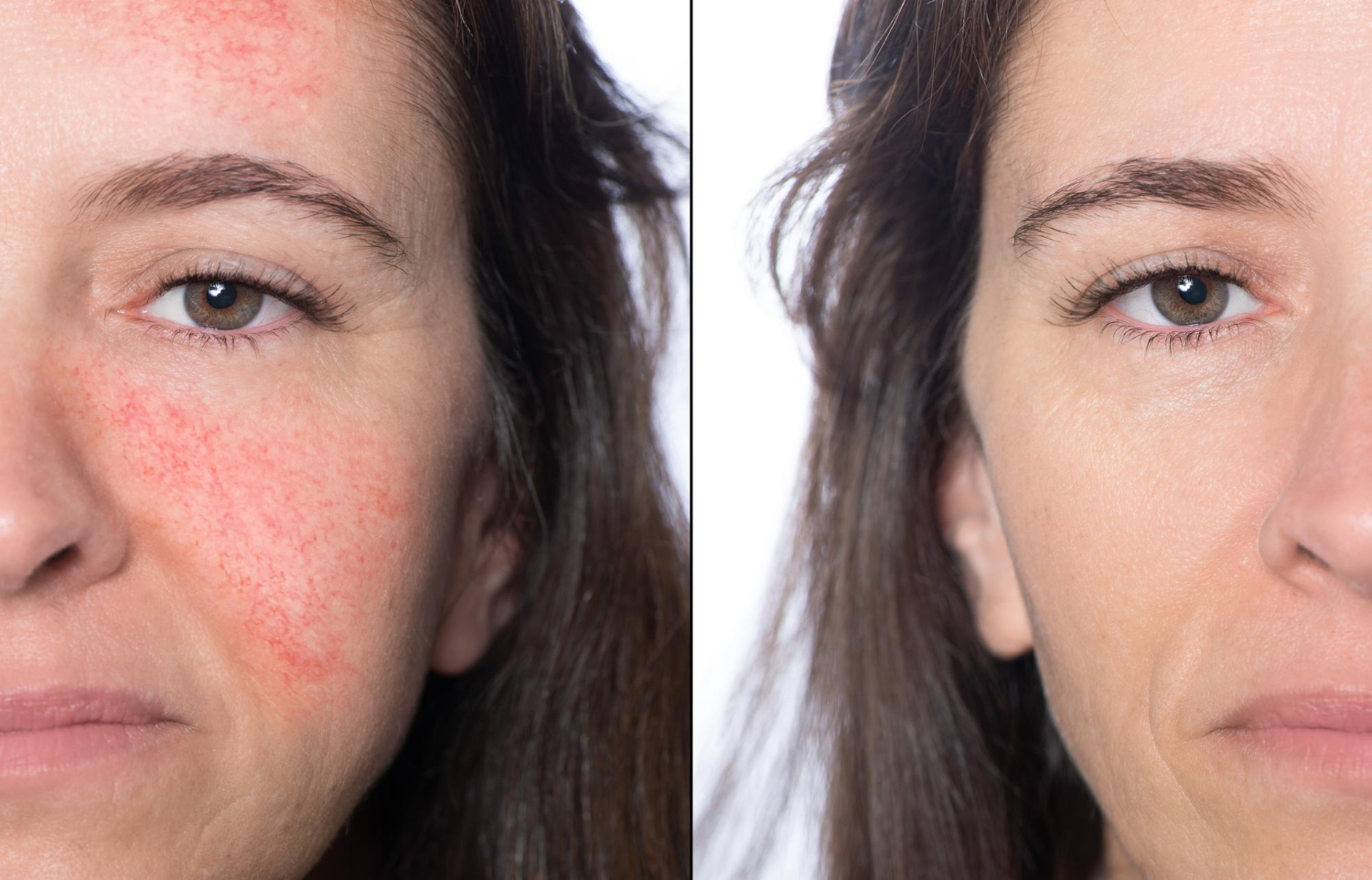 Couperose-viso-dermatologa-pozzi-bergamo
