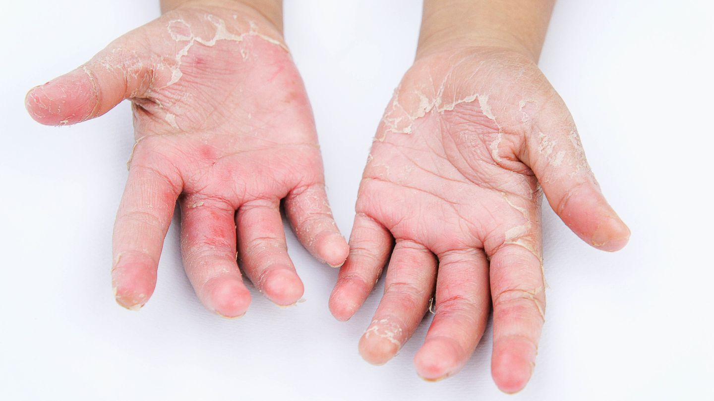 _Desquamazione della pelle - dermatologa pozzi bergamo