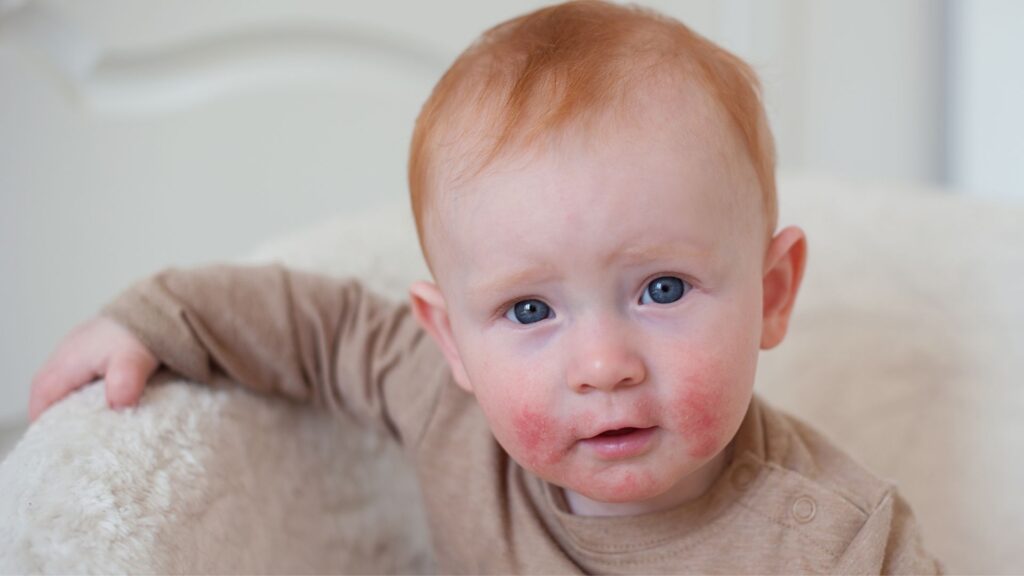 dermatite atopica nei bambini - bergamo - dermatologa pozzi (1)