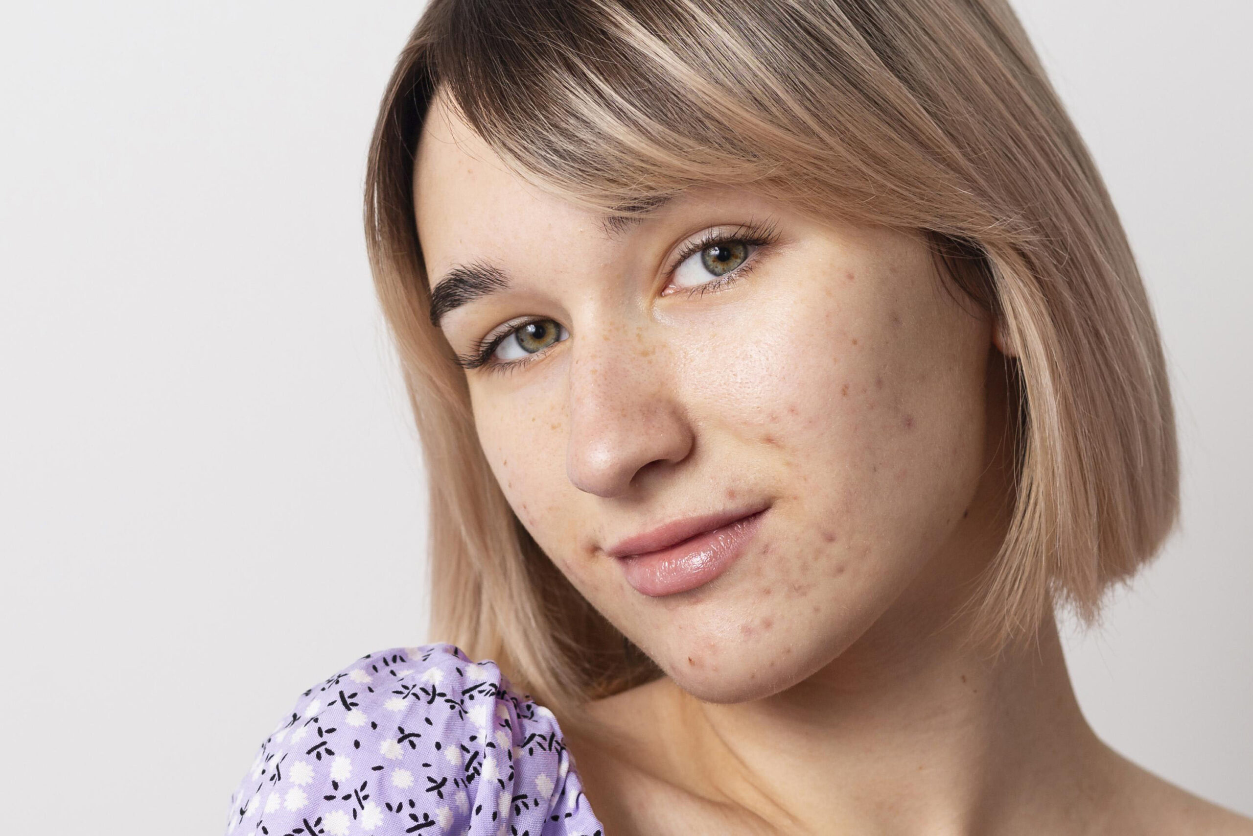 Acne tardiva da stress